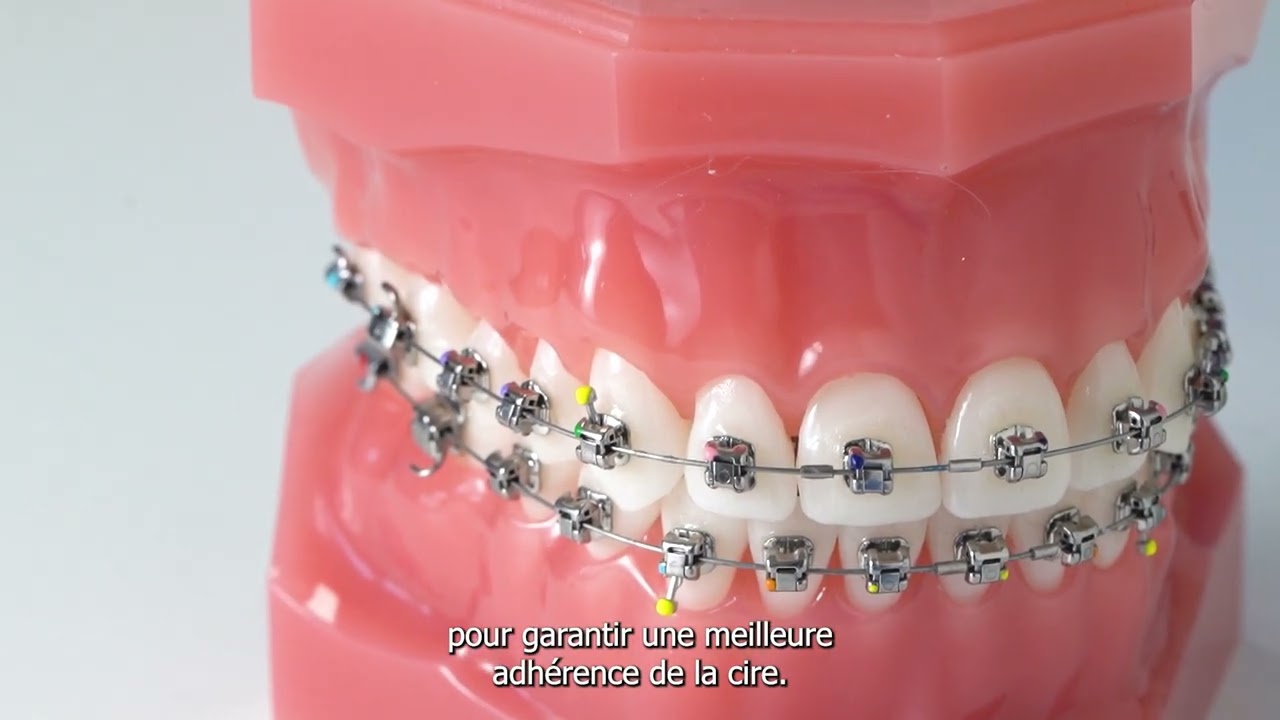 Comment utiliser la cire | Soulager les irritations avec un appareil multi-attaches (brackets)