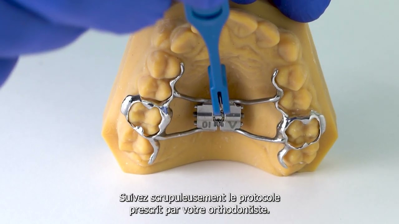 🦷 Qu’est-ce qu’un disjoncteur palatin en orthodontie ?