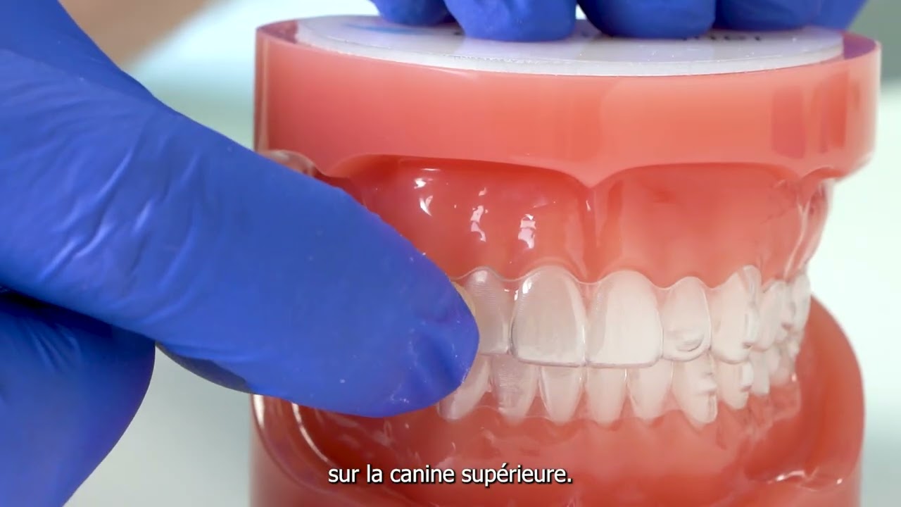Élastiques de Classe II avec aligneurs |Comment les poser dans un traitement orthodontique invisible